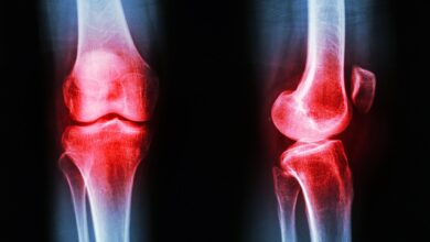 Photo of Артрит коленного сустава: симптомы и лечение