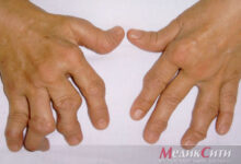 Photo of Ревматоидный артрит: симптомы и методы лечения