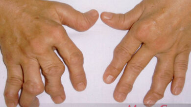 Photo of Ревматоидный артрит: симптомы и методы лечения