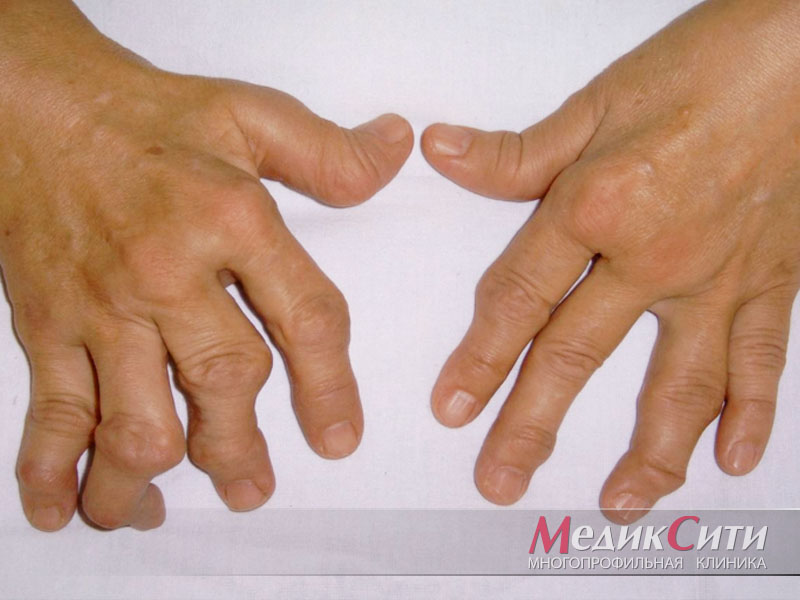 Фото 30 — Ревматоидный артрит: симптомы и методы лечения