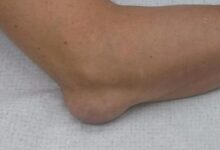 Photo of Бурсит плечевого сустава: симптомы и лечение