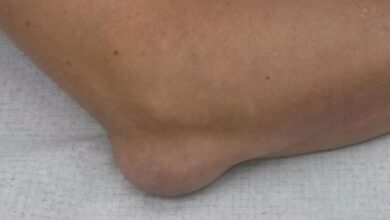 Photo of Бурсит плечевого сустава: симптомы и лечение