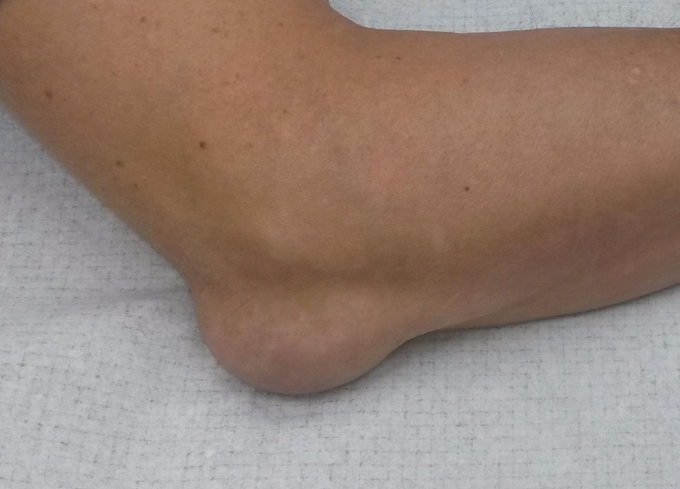 Фото 40 — Бурсит плечевого сустава: симптомы и лечение