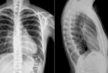 Photo of Остеохондроз шейного отдела позвоночника