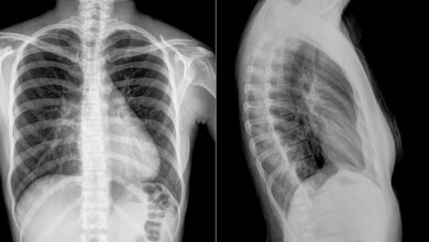 Photo of Остеохондроз шейного отдела позвоночника