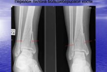 Photo of Перелом позвоночника: диагностика и лечение