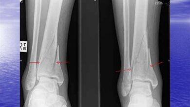 Photo of Перелом позвоночника: диагностика и лечение